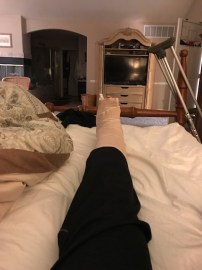broken leg